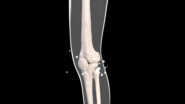 3D Healing of Leg and Knee Bones | Alpha Channel