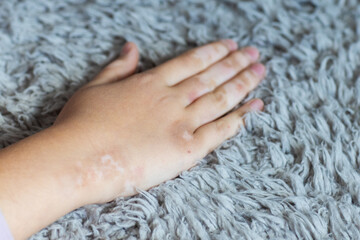 Child's hand with vitiligo resting on a soft gray carpet © Алина Бузунова