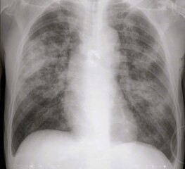 Chest x ray of  pneumonia radiology image, lung infection 	