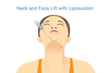 Neck and Face lift with Liposuction. woman lifts her head to allow the Cannula needle to be inserted under her chin for liposuction. Reducing excess body fat with medical technology.