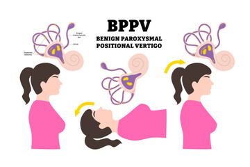 BPPV or benign paroxysmal positional vertigo syndrome. Labeled woman with various position and ear canal disease anatomy with spinning and dizziness sensation cause. Medical education poster.