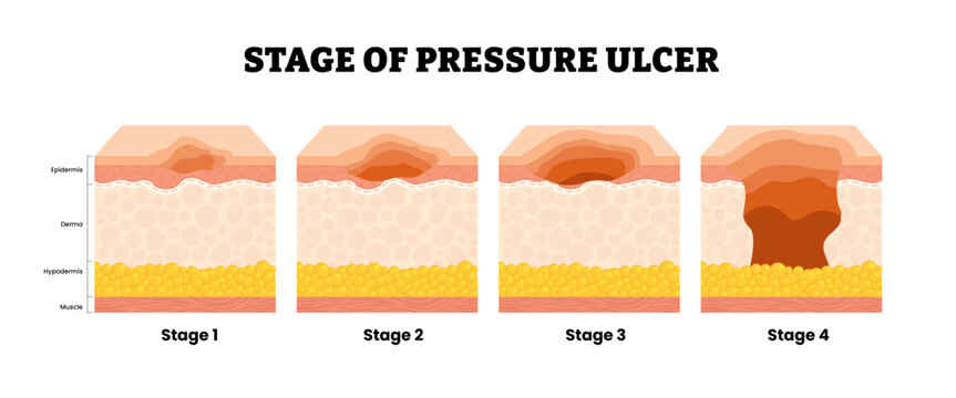 Stages of pressure ulcer stages first to fourth stage. Labeled skin structure epidermis, dermis, hypodermic, muscle. Bedsores pressure ulcer injury skin underlying tissue. Medical science illustration