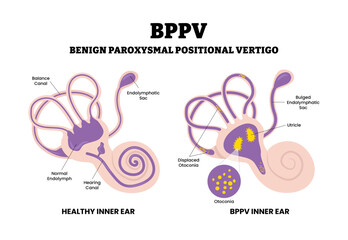 Benign Paroxysmal Positional Vertigo BPPV. Labeled displaced otoconia, utricle, bulged endolymphatic sac, hearing canal. Inner ear disorder. Flat vector. Medical science educational illustration