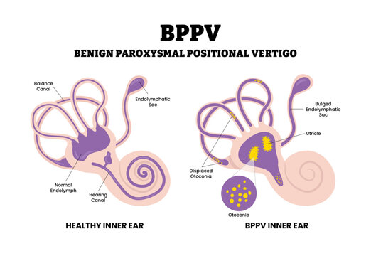 Benign Paroxysmal Positional Vertigo BPPV. Labeled displaced otoconia, utricle, bulged endolymphatic sac, hearing canal. Inner ear disorder. Flat vector. Medical science educational illustration