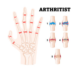 Stages of rheumatoid arthritis stages in fingers bone or human hand. deformation of the fingers and knuckles. Auto immune disease, inflammatory. Medical science educational illustration