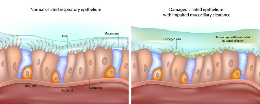 Medical illustration shows a comparison between normal ciliated respiratory epithelium and damaged epithelium with impaired mucociliary clearance. Healthy Versus Impaired Ciliated Epithelium 