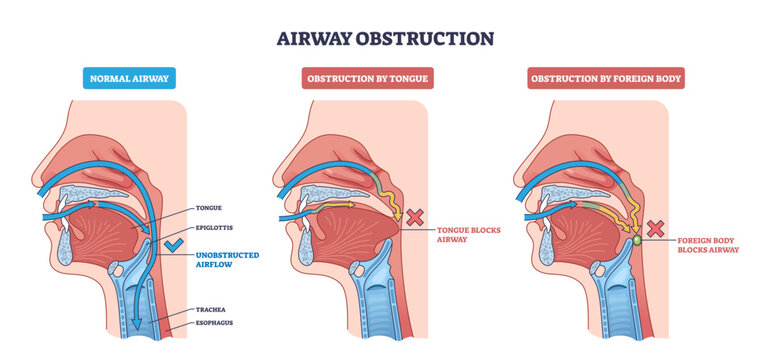 Airway obstruction diagram shows normal airflow vs blockage by tongue or foreign body, key parts, tongue, epiglottis, trachea, transparent background.