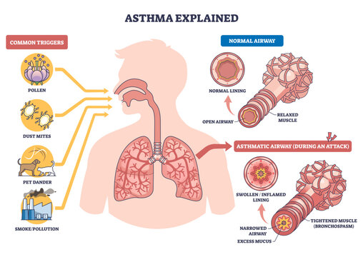 Asthma explained diagram shows lungs, bronchi, and triggers, contrast normal vs asthmatic airways showing inflammation, mucus, and tight muscles causing breathing trouble, transparent background.