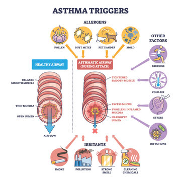 Asthma triggers diagram shows healthy vs asthmatic airway with allergens and irritants causing swelling and mucus, key objects, airway cross-sections, pollen, smoke, transparent background.