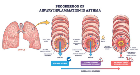 Airway inflammation progression in asthma shows normal to attack stages, with narrowing and mucus blocking airflow, lungs, bronchiole cross-sections, mucus plug, transparent background.