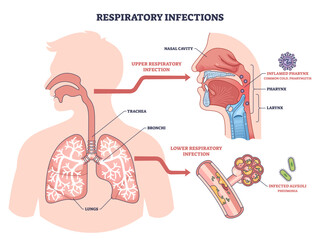 Respiratory infections brief outline shows upper and lower tract disease, highlighting lungs, pharynx, and alveoli in a clear medical infographic for education, transparent background.