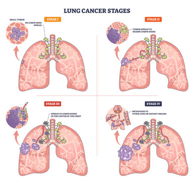 Lung cancer stages presented in a brief medical graphic, lungs, tumors, and lymph nodes show progression from Stage I to IV with metastasis, transparent background.