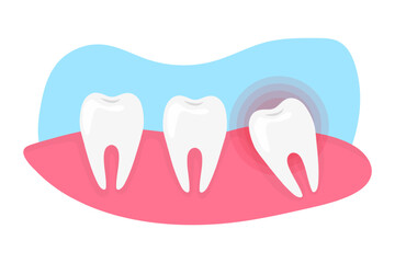 Wisdom Tooth pain and inflammation. Need of tooth extraction.