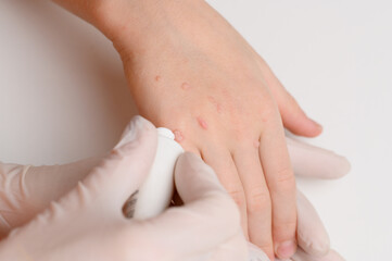 Naklejka premium Doctor wearing gloves applies special medication to child's hand affected by warts caused by human papillomavirus, removing them. Verruca vulgaris . Human papillomavirus, HPV. Common wart removal.