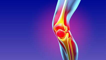 Detailed 3D illustration of an inflamed knee joint showing pain, injury, and swelling. Ideal for medical articles, healthcare education, physiotherapy, orthopedics, and anatomy visuals