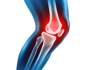 Human knee joint x-ray with red pain area indicating inflammation or injury concept for orthopedic surgery arthritis and sports medicine healthcare visualization isolated on a white surface