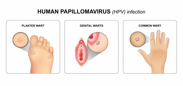 Human Papillomavirus (HPV) infection flashcard