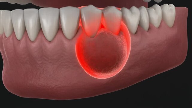 Animated depiction of a tooth extraction process from the lower jaw, revealing severe gum inflammation and infection in the alveolar bone, illustrating dental pain and disease.