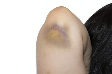 Close-up of Large Bruise or Hematoma on Elbow Showing Multiple Healing Stages and Discoloration