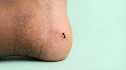 Fototapeta premium Closeup of mosquito biting human heel skin showing red irritation and risk of insect borne disease on pastel green background