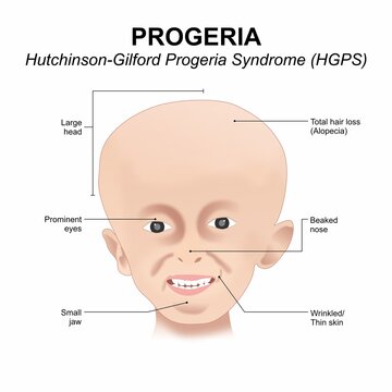 PROGERIA (HGPS) Hutchinson&ndash;Gilford Progeria Syndrome