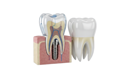 Detailed 3D Dental Implant Cross Section and Tooth Anatomy Showing Root Canal System and Metal Post on Transparent Background Realistic Medical Illustration