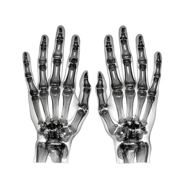 Radiographic view of two human hands, showing skeletal structure