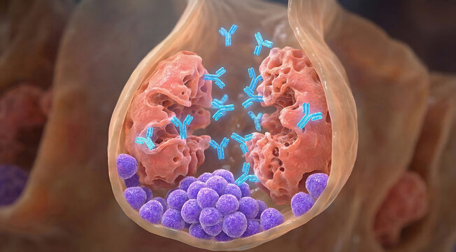 Autoimmune Gastritis Mechanism: 3D illustration of Autoantibodies attacking Parietal Cells with basal ECL Cell Hyperplasia inside Gastric Gland