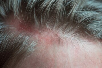 Close-Up of Scalp with Grey Hair and Sensitive Skin Redness: Personal Care and Follicular Health in Hairline and Dermatology Cosmetic Products for Aging, Natural, Blonde, Shiny Shair.