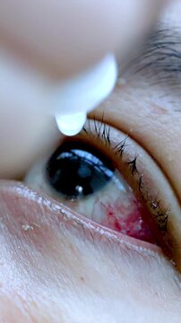 Close-Up Eye Drop Application for Red, Irritated Eye