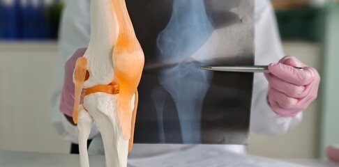 Traumatologist examining x-ray and showing problem on anatomical model of knee closeup . Diagnosis...