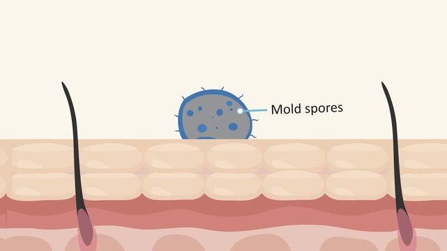 Animation: Fungal spores germinate into germ tubes, form invasive hyphae penetrating epidermis, release enzymes, trigger inflammation and immune response, leading to vesicles and papules.