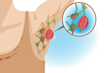 Illustration of Axillary lymphadenitis or lymphadenopathy