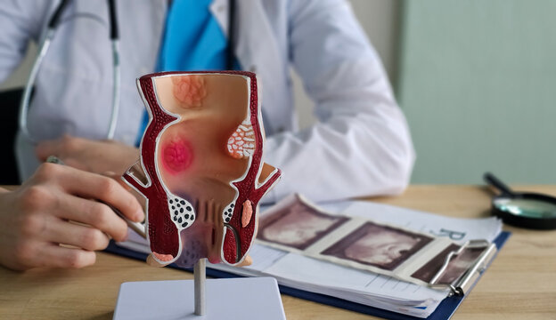 Anatomical model of rectum with hemorrhoids in clinic