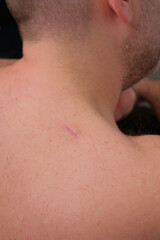Close-up of a man&rsquo;s neck showing a healing surgical scar after atheroma (epidermal cyst) removal, illustrating post-operative recovery and dermatology treatment care