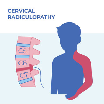 Vector medical illustration of cervical radiculopathy showing a herniated disc and corresponding pain areas in the neck, shoulder and upper limb. Clean anatomical visualization suitable for medical, e