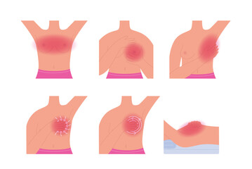 Breast cancer self-exam. Infographic on step-by-step breasts self exploration instruction to prevent oncology. Vector illustration for health care flyers, brochures, web resources.