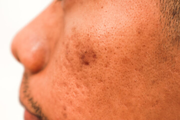Close up Macro Shot Of Man Skin With Dark Spot And Pores And Beard Stubble Against White Background