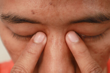 Close Up On A Man S Face With Eyes Closed And Fingers On His Nose With Natural Lighting