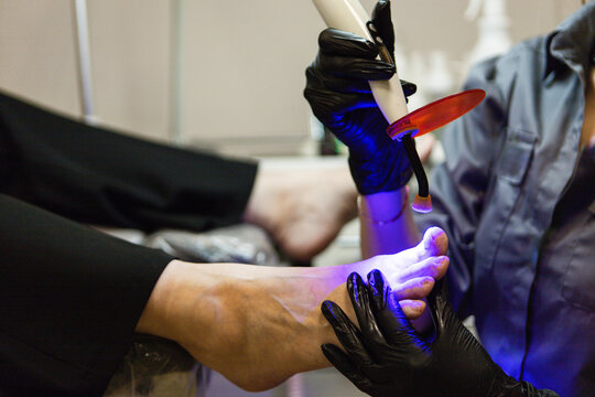 Professional podiatrist treating nail diseases with violet woods lamp light showing close view of affected nails and clinical procedure highlighting podiatry treatment and modern foot care environment