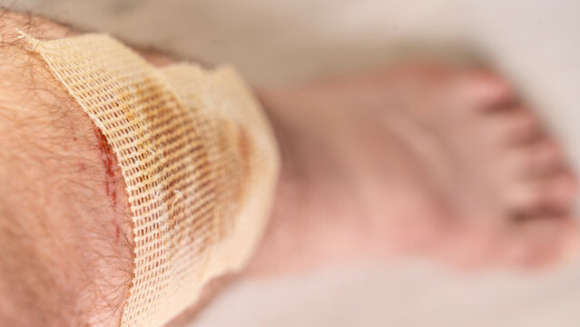 A man with a severe shin injury. The gauze bandage is soaked with medicine to heal the wound on the patient's sore leg. High quality photo