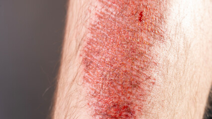 a man's shin with a bleeding abrasion. Severe injury. High quality photo