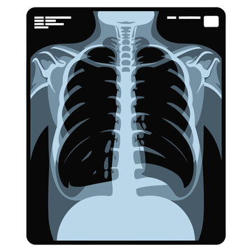 Chest X-Ray Vector Illustration &ndash; Human Ribcage and Lungs Radiology Scan Image for Medical Diagnosis, Healthcare, Hospital, Anatomy, and Radiography Design