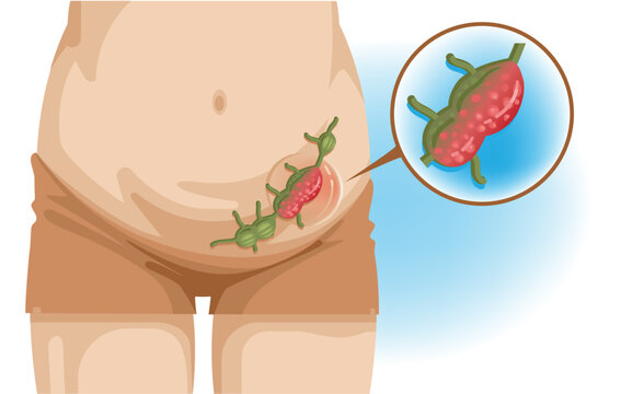 illustration shows swollen lymph nodes in the groin area