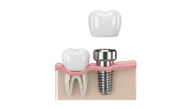 Close Up Dental Implant Procedure Showing Tooth Root Bone Replacement with Metal Screw and White Crown on Transparent Background - Powered by Adobe