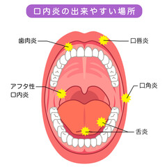 口内炎の出来やすい場所　口の中　医療