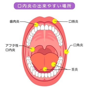 口内炎の出来やすい場所　口の中　医療