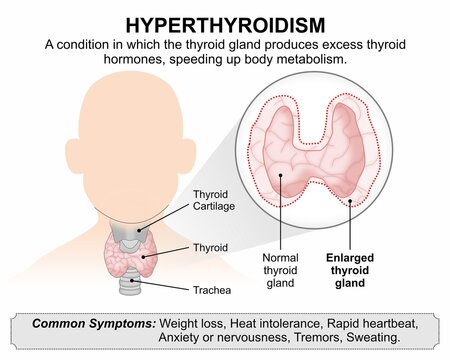 Hyperthyroidism Medical Infographic Flashcard Illustration