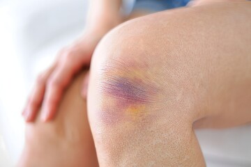 Fototapeta premium Bruised Knee Close-Up - Injury and Healing