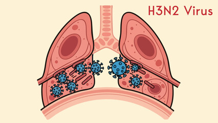 H3n2 influenza virus infection illustration showing microscopic pathogens attacking human respiratory system lungs